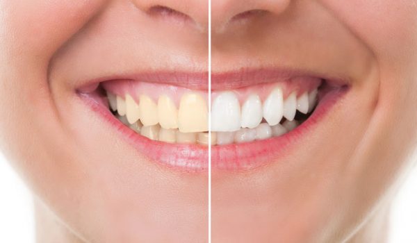 راههای طبیعی برای سفید کردن دندانها در خانه