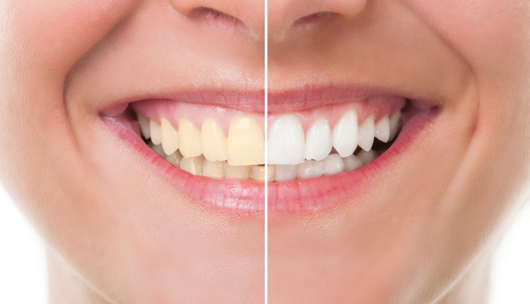 راه‌های طبیعی برای سفید کردن دندان‌ها در خانه 
